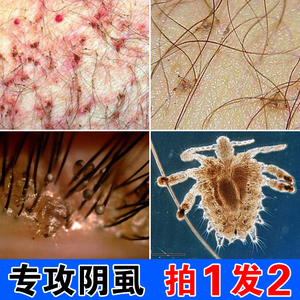 虱子药男女士私处瘙痒百部酊除灭阴虱虫卵一扫光去除头虱喷剂正品