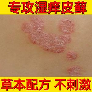 大腿内侧真菌感染专治牛皮癣疥疮药治痘痘的药膏治疗头皮癣的药膏
