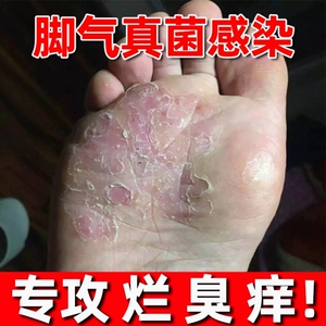 去脚臭汗脚味治香港脚药水严重脚底脱皮溃烂灰指甲真菌顽固药膏癣