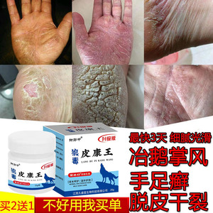 治疗真菌感染鹅掌风手癣手足癣手足藓手藓手气手蜕皮手指脱皮药膏