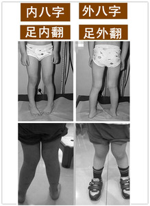 婴幼儿足内翻足外翻矫正器内八字外八字矫正鞋儿童脚踝畸形带鞋垫