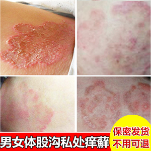 屁眼屁股两边痒专用癣药大腿内侧外阴皮肤藓阴囊铜钱癣蛋蛋止痒膏