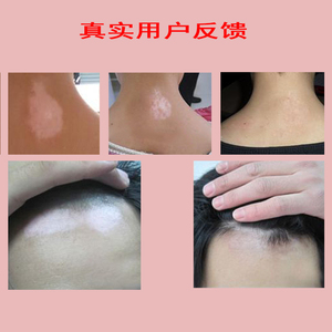 白颠风外用药白癫疯黑色素生长癜白斑净软膏治消白克星特效偏方膏