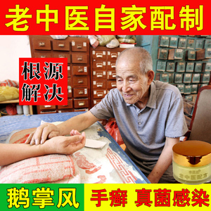 治疗鹅掌风手足癣手癣手藓手足藓手气膏手蜕皮手脱皮药膏真菌感染