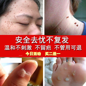 去瘊子膏瘊疣平