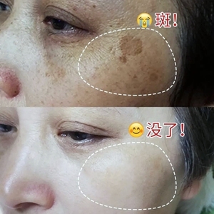 美白祛斑霜黄褐斑正品淡斑去遗传斑雀斑日晒斑老年斑妊娠斑黑斑点