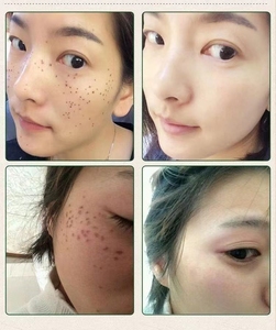 点痣膏稀释液.点痣笔雀斑.提取笔点斑美容