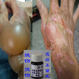 珍石烧伤膏