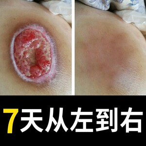 拔毒膏疮