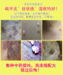 治疗男女菜花状去除疣体膏私处龟头包皮外阴尖锐湿疣医用外用去