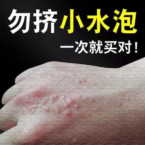 0051人付款淘宝鹅掌风手癣真菌感染汗疱疹手脚脱皮干裂软膏藓水泡手气