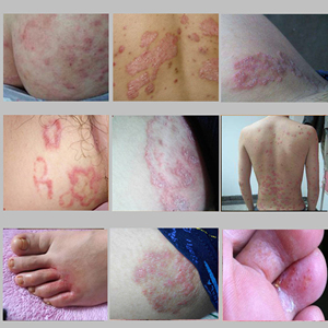 肤毒清外阴湿疹止痒中药膏皮炎皮肤外用瘙痒抑菌过敏红疹私处专用