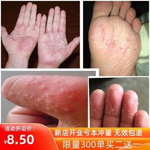 tb390965718945淘宝特效汗泡疹手足头皮廯季节性手痒脱皮杀真菌手上