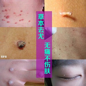 丝状疣去除膏日本