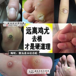 去治鸡眼膏肉刺猴子神器脚上长鱼鳞痣祛瘊疣灵刺猴药趾疣瘊子