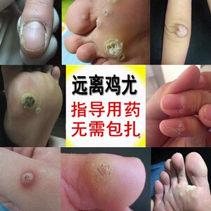 脚底脚钉老茧祛根神器祛脚垫鸡眼贴鸡眼膏肉丁脚趾跖疣肉刺瘊子