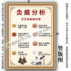 中医艾灸养生艾艾贴 灸痕分析 看痕识病海报挂图ppkt板装饰画广告