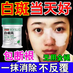 【拨裉】白殿癜风外用黑色素生长药膏快速消白斑专用治疗特效的净