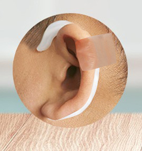 婴儿耳朵矫正器固定