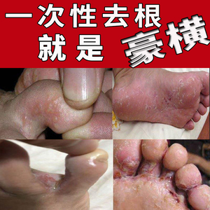 烂脚丫药脱皮糜烂治脚掉皮脚丫子痒脚趾缝开裂水泡除脚臭气脚喷雾