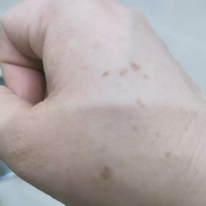 正品祛斑霜美白去除手上老年斑手背脸部专用药老人斑一抹净神器