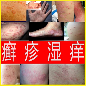 仁南大药房旗舰店天猫福元醋酸曲安奈德尿素软膏 10g*1支cf9 盒皮炎