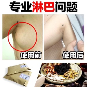 淋巴结核贴膏
