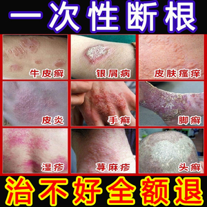 治疗牛皮廯藓银屑病止痒抑菌皮肤瘙痒湿疹去根股体癣专用祛癣药膏
