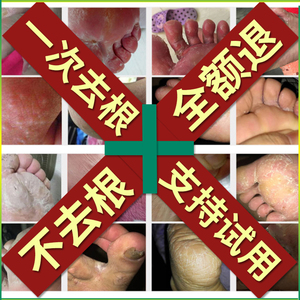 脚药膏脱皮止痒外用