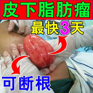 去除神器36种皮下多发性脂肪瘤消瘤膏硬块肿块去粉瘤囊肿115人付款35