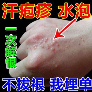 汗状疱疹药膏小水泡汗孢疹专用治疗手气手癣脱皮去根止痒抑菌皮肤