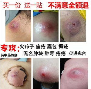 00 119人付款  淘宝 拔毒膏治火疖子屁股坐板疮肿硬块毛囊毒疮包药膏