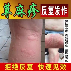 荨麻疹过敏湿疹止痒断根治疗急性慢性风团皮肤病瘙痒克星专用药膏