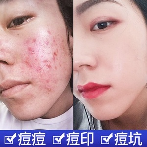 祛痘洗面奶女控油去油中学生美白祛螨虫抗痘黑头青春期豆淡化痘印