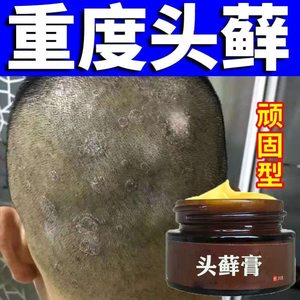 头皮屑头癣的药真菌感染头皮藓癣药膏头皮藓结痂洗发水牛皮头皮藓