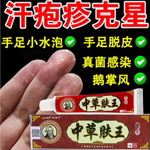 手癣膏真菌感染手足癣脱皮干裂水泡汗疱疹湿疹止痒去根鹅掌风药膏