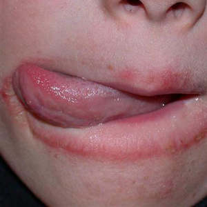 唇炎唇膏修复药用