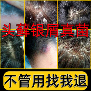 头皮癣药膏真菌感染治疗头藓头皮屑癣头皮真菌感染外用止痒洗发水