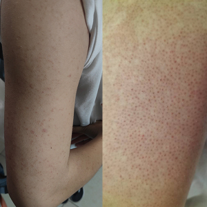 去鸡皮肤疙瘩毛囊角化鸡皮肤救星去除神器全身小腿手臂上的小疙瘩