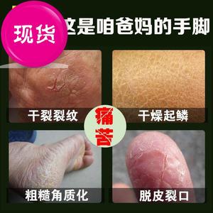 七安堂手裂脚裂膏v干裂手足底脚后跟干燥防开裂口皲裂护肤霜膏手