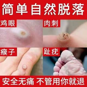 刺窝贴瘊疣平手指疣去猴灵膏瘊子甲周疣专用药脚上鸡眼丝状疣药膏
