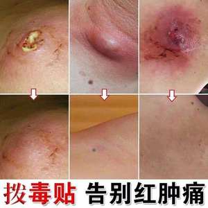 拔毒膏吸脓吸肿成人毛囊湿痒脓贴痘痘贴断痒乌蛇暗疮脓头硬块祛痘