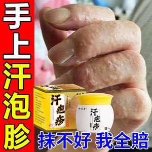 专治汗疱疹手足癣脱皮手气手痒真菌感染手上起小水泡止痒去根药膏