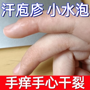 手脱皮药膏