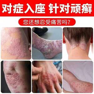 癣药膏外用皮肤堂