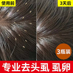 虱子药儿童头虱子小女孩头发虱立净去除虱卵头长虱子一扫光百部酊
