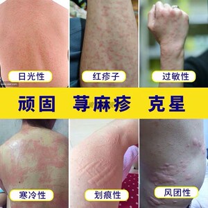 荨麻疹过敏止痒断根胆碱能性划痕荨麻疹风团专用药膏日本外用克星