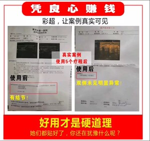 汝必消乳康凝胶乳腺散结贴万古康通乳腺贴小叶增生贴潘淑凤乳腺贴