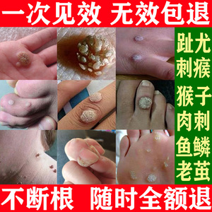 刺猴去除正品脚肉刺肉粒疙瘩跖疣瘊子净猴子专用膏去根药灵贴神器