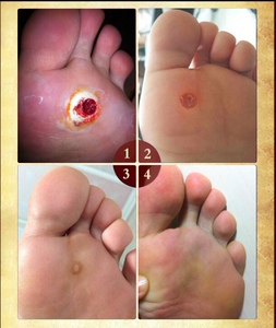 刺猴猴子肉去除膏肉刺去脚雞眼贴雞眼膏正品专用手足部手部鸡尤净